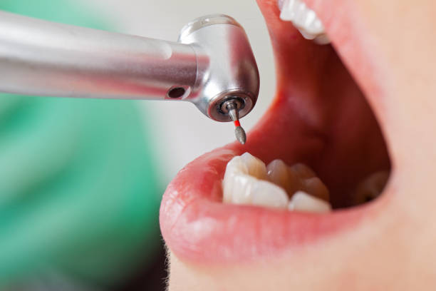 Best Emergency Root Canal Treatment in East St Louis, IL